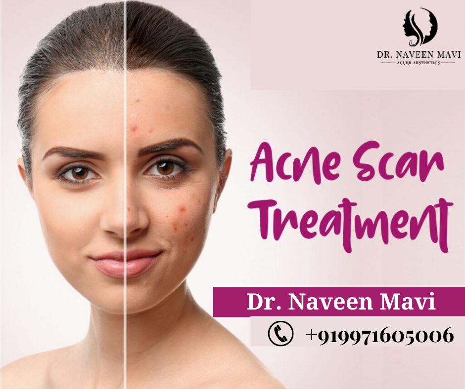 Effects of Acne Scar